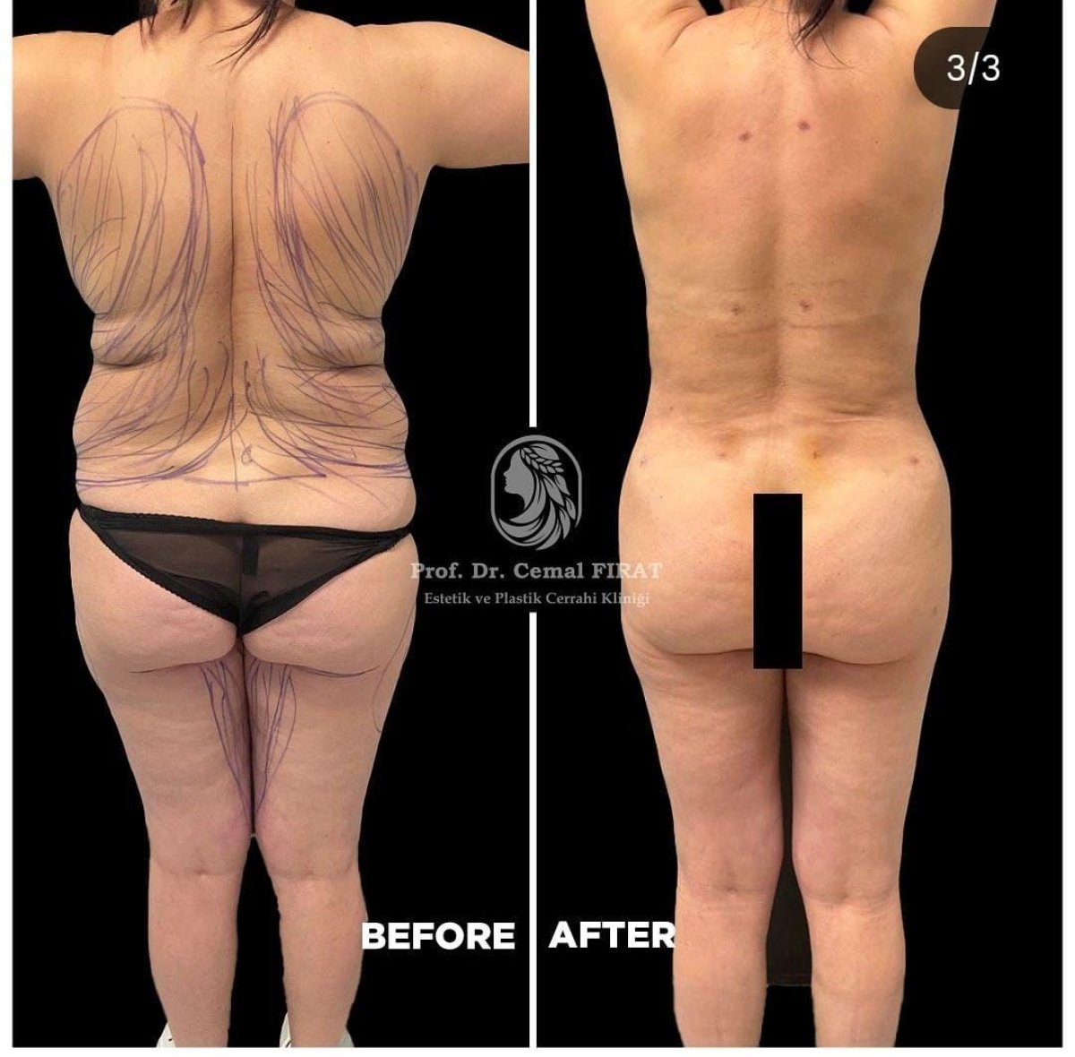 Before and after back liposuction results at Medical Park Antalya Hospital Complex, body contouring
