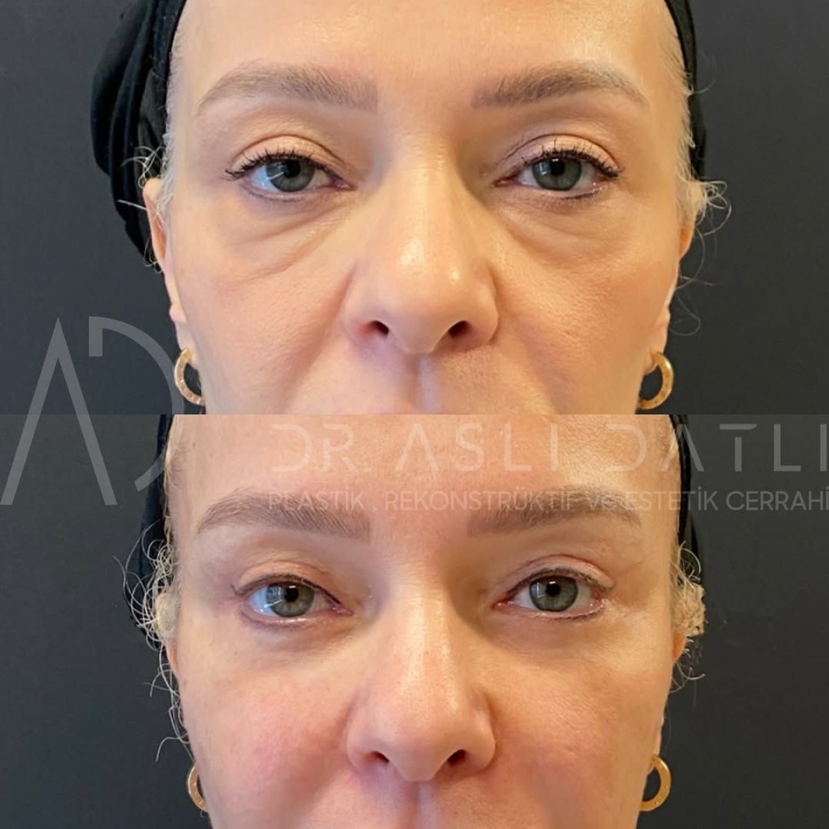 Resultados de lifting facial antes y después en Liv Hospital Ulus, rejuvenecimiento visible