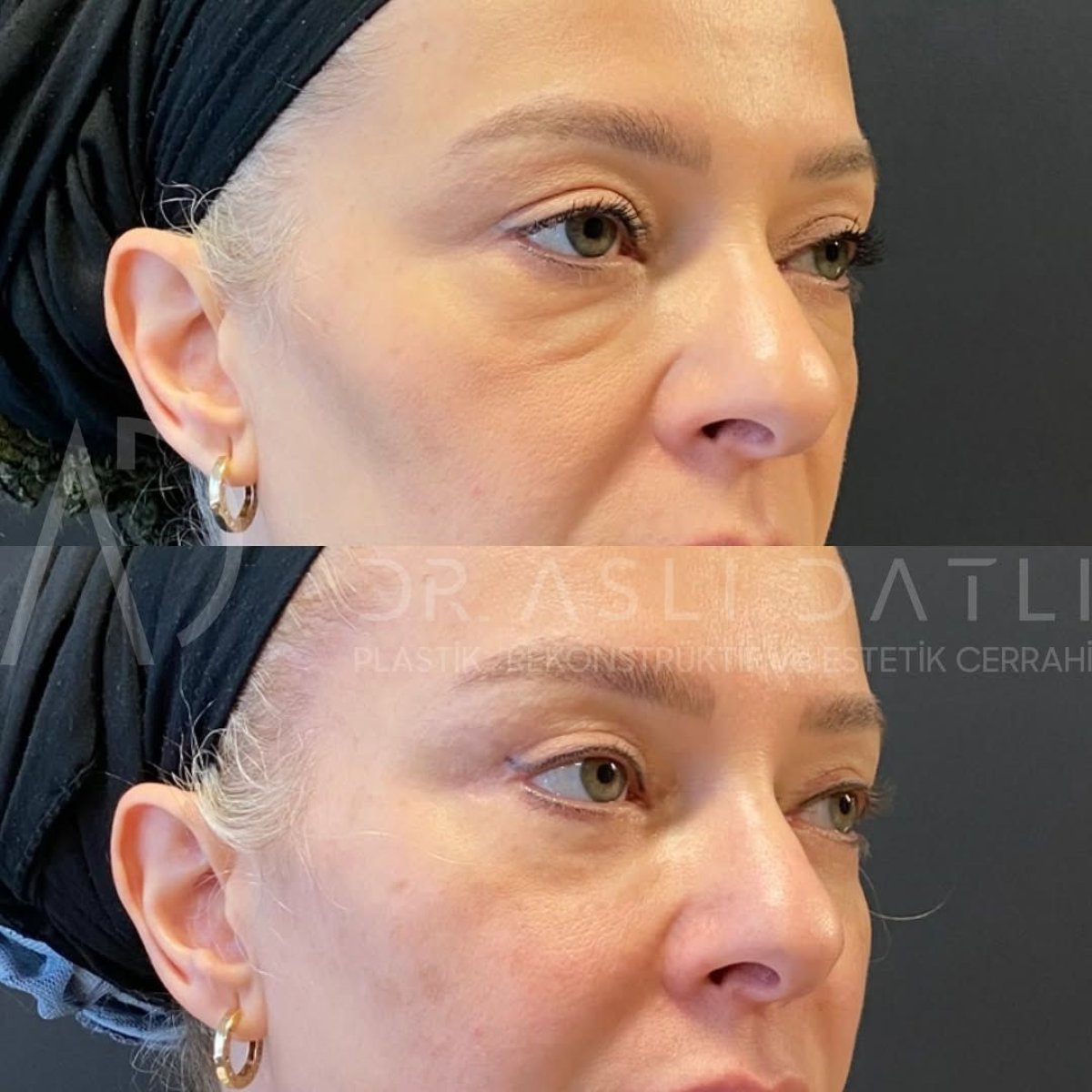 Facelift before and after results at Liv Hospital Ulus, visible facial rejuvenation and lift