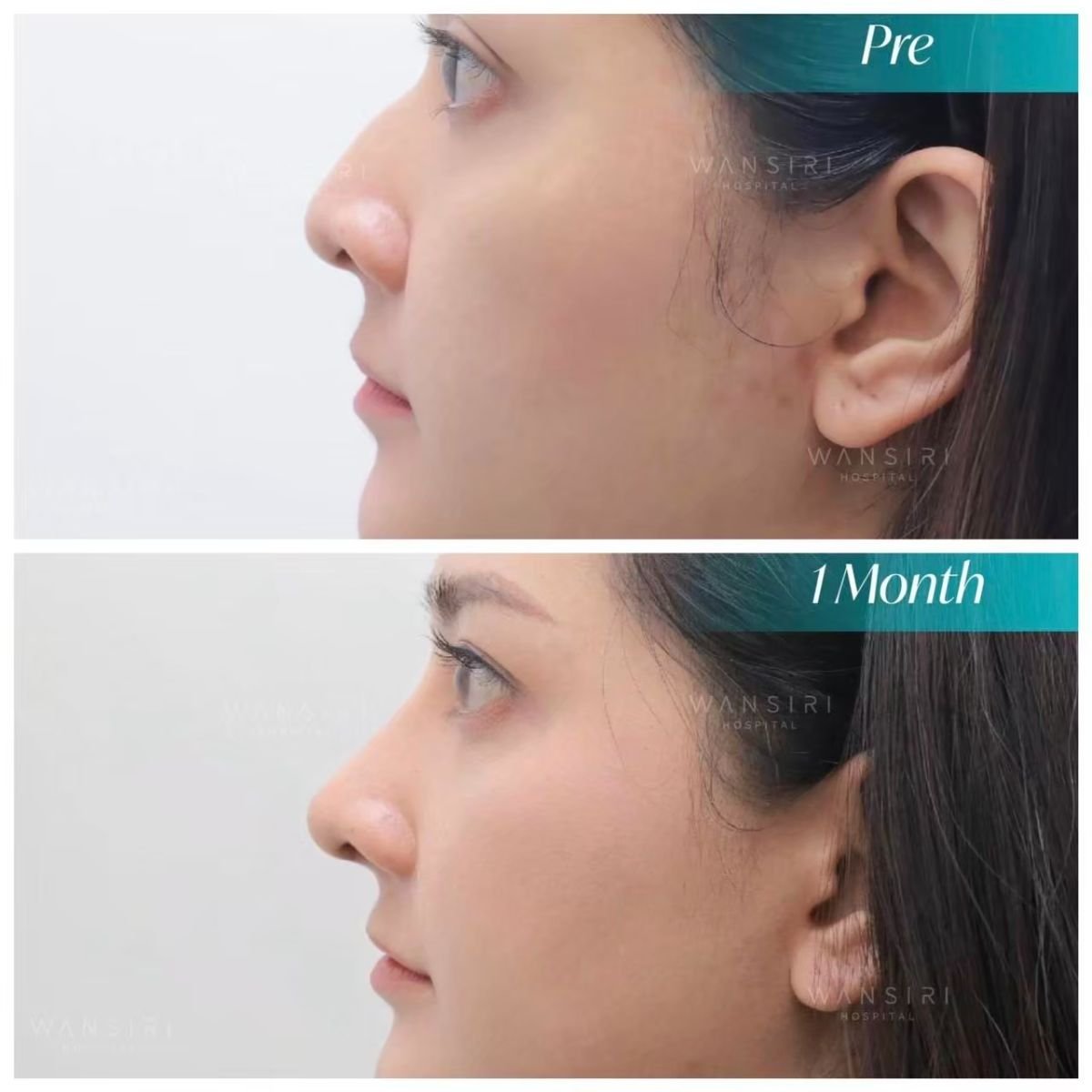 Résultats avant et après rhinoplastie à Wansiri Hospital, remodelage du nez après 1 mois