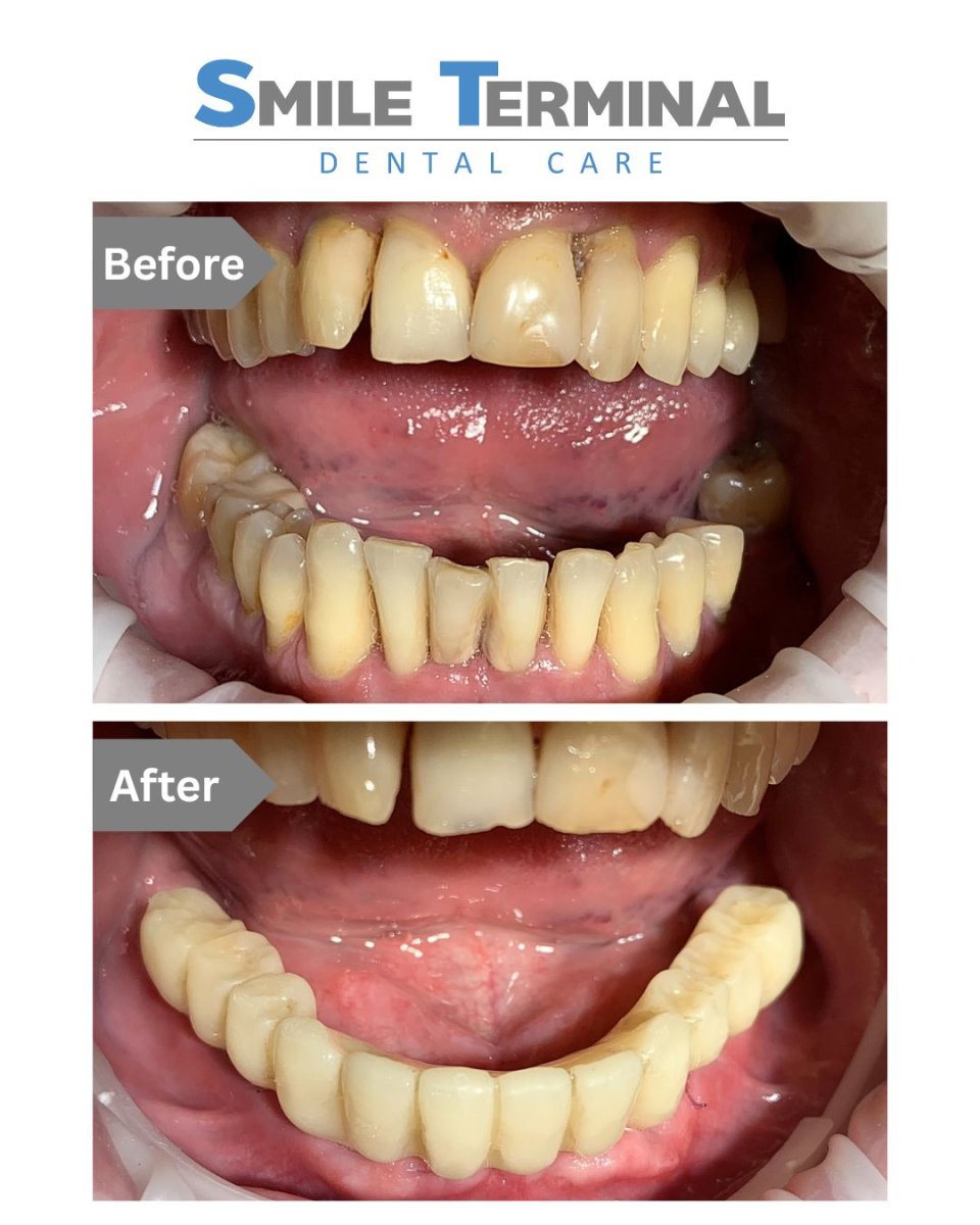 Resultados de implantes dentales antes y después en Smile Terminal Dental Care, mejora dental inferior