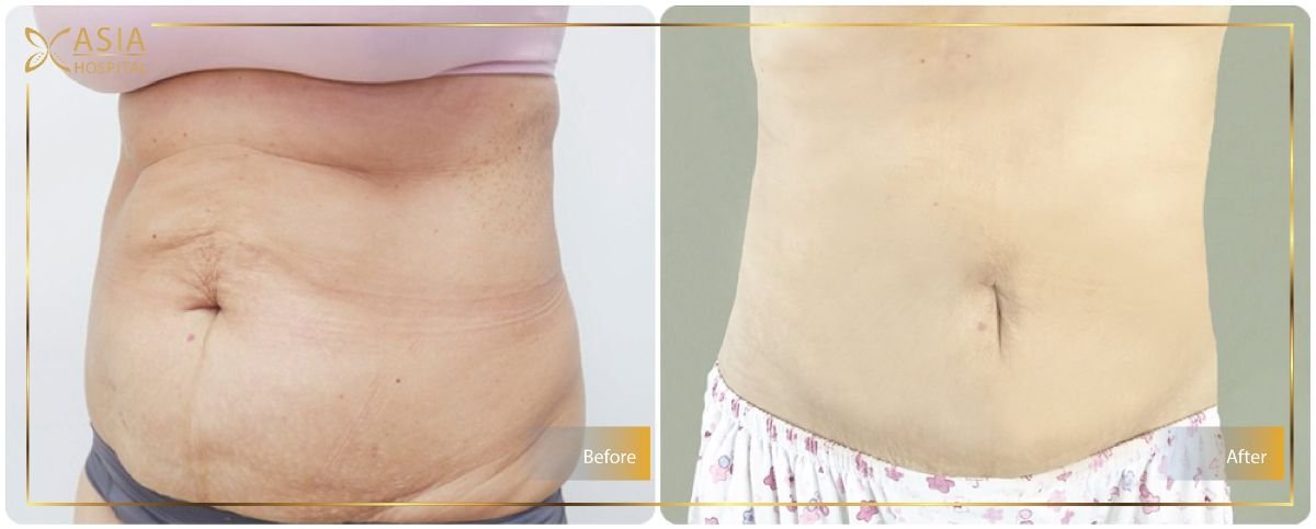 Before and after liposuction results at Asia Cosmetic Hospital, visible abdominal contouring