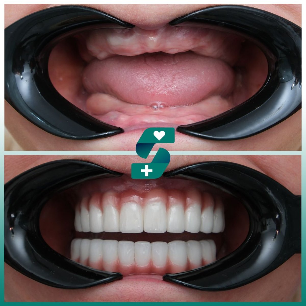 Before and after All-on-4 dental implants result at Soraca Med, full smile restoration