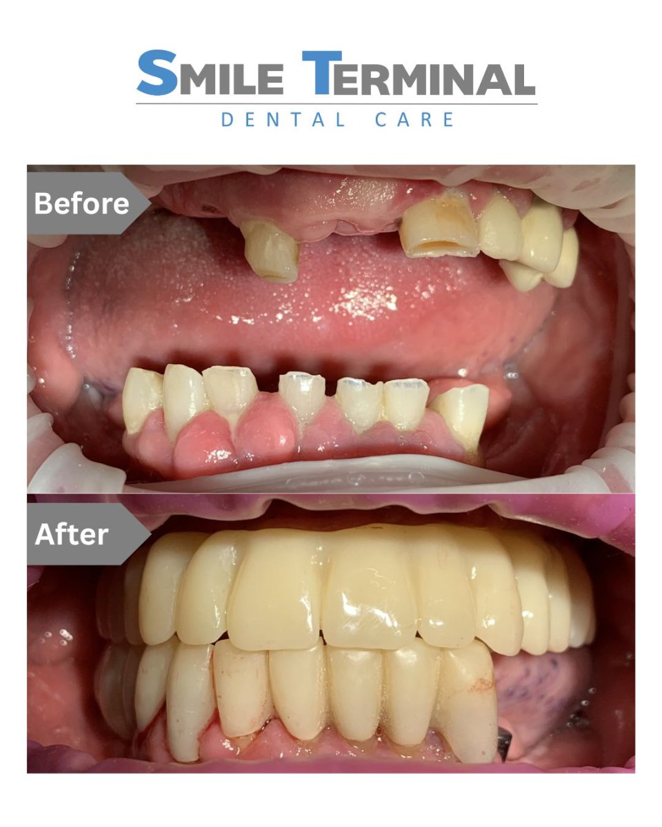 Before and after dental implant results at Smile Terminal Dental Care – restored full smile