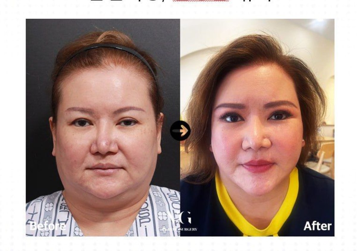 قبل وبعد إزالة دهون الخدود في VG Plastic Surgery، نتيجة تحديد الوجه الأنحف