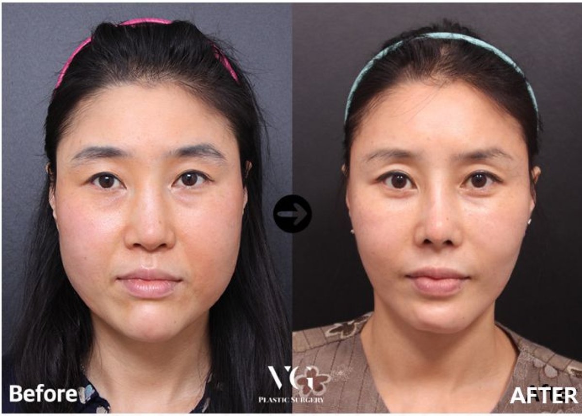 Résultats avant/après extraction de boules de Bichat chez VG Plastic Surgery, visage affiné