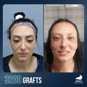 DHI Hair Transplant with PRP Session — 5★ Hotel & VIP Transfer Included - photo 5