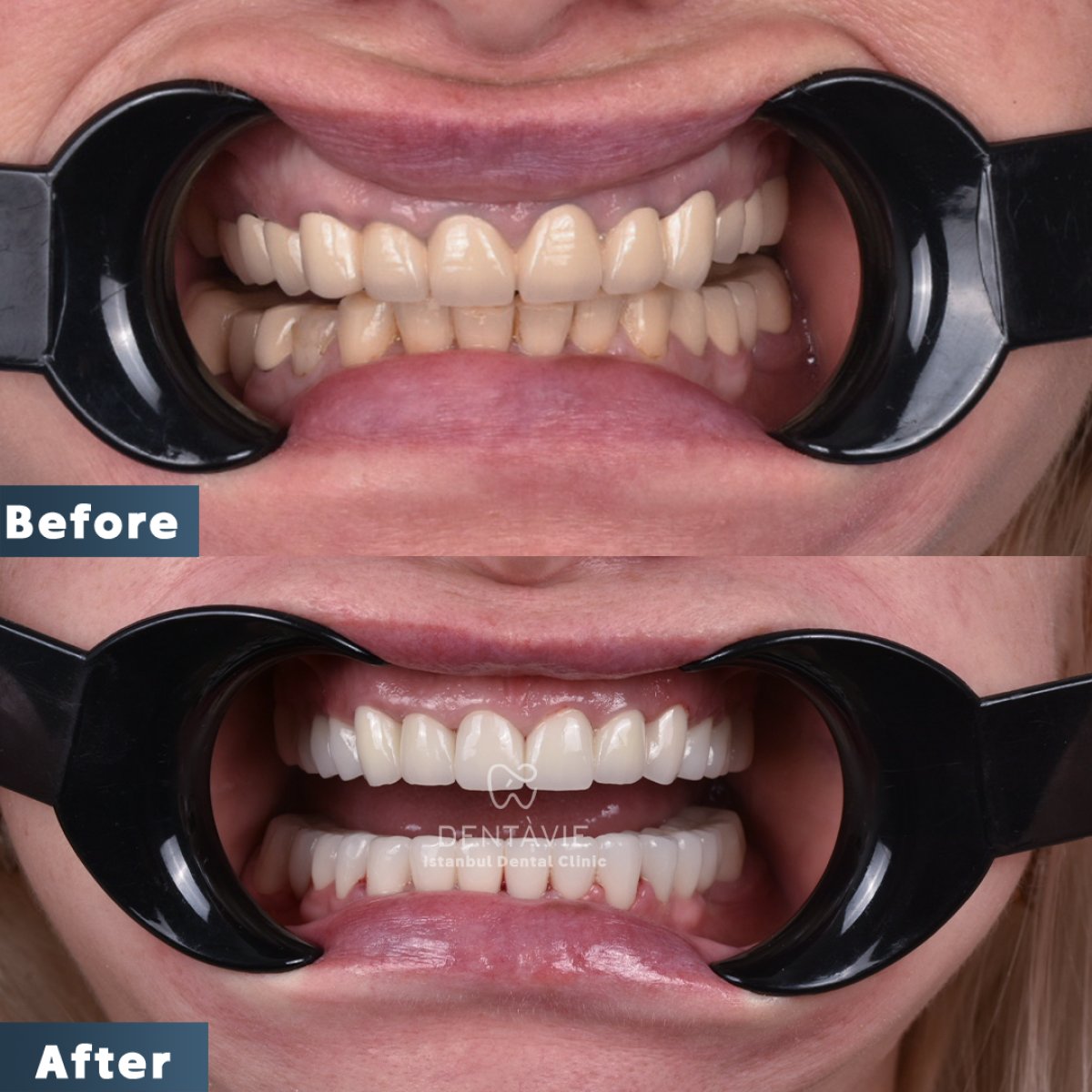 نتائج قبل وبعد ابتسامة هوليود في Dentavie Istanbul Dental Clinic، أسنان أكثر بياضًا