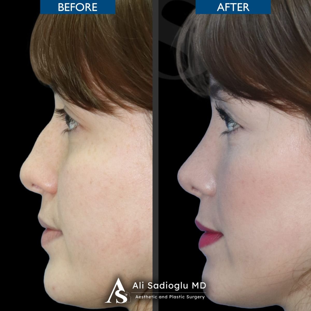 نتائج تجميل الأنف قبل وبعد في عيادة Dr. Safa Manav، تحسين شكل الأنف