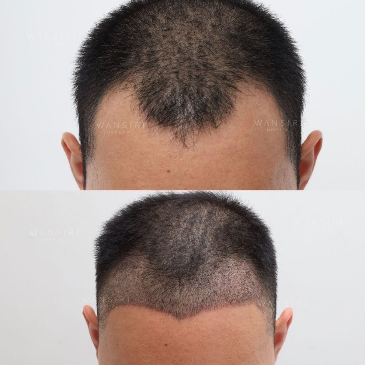 Before and after hair transplant results at Wansiri Hospital, improved hairline restoration