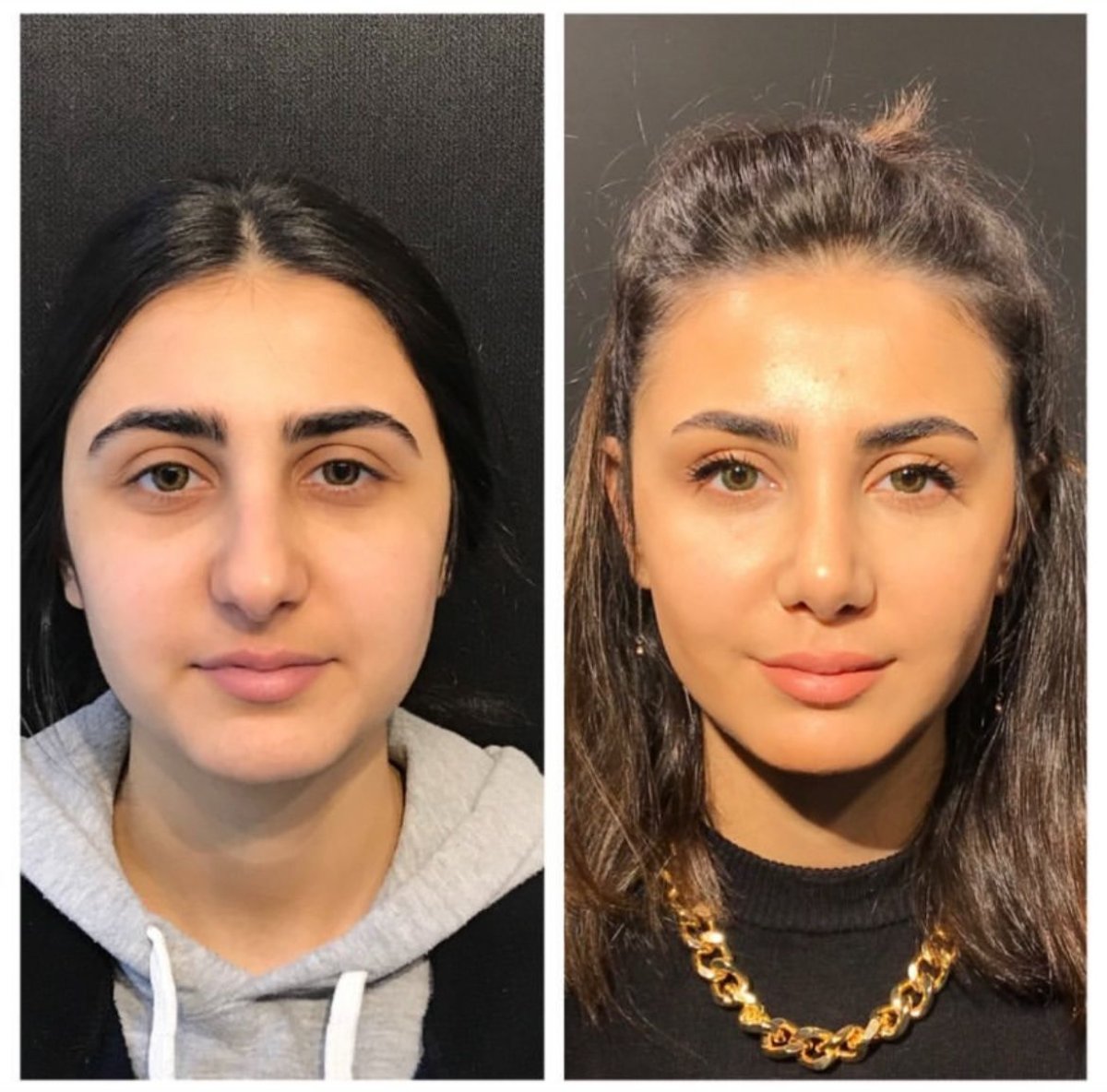 Before and after buccal fat extraction results at Prof. Furkan Karabekmez's Aesthetic Surgery Clinic
