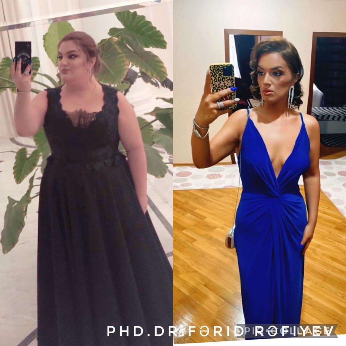 Before and after gastric sleeve surgery at Liv Bona Dea Hospital Baku, visible weight loss result