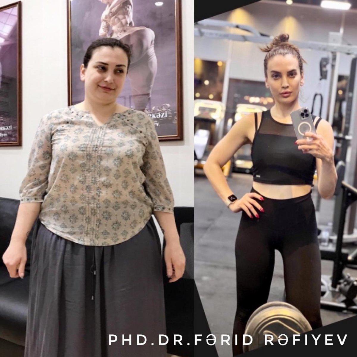 Before and after gastric sleeve surgery results at Liv Bona Dea Hospital Baku, weight loss visible