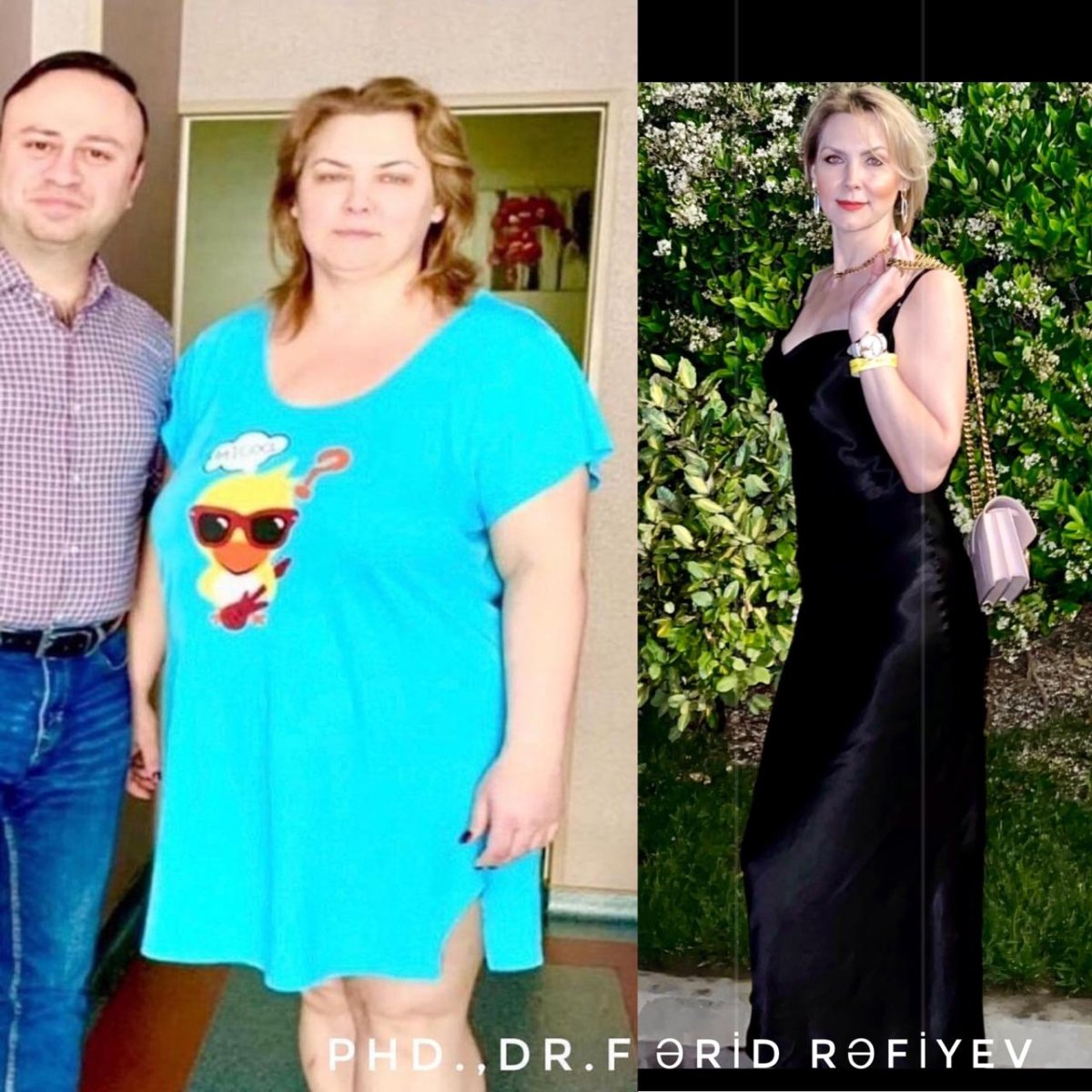 Before and after gastric sleeve surgery at Liv Bona Dea Hospital Baku – weight loss result