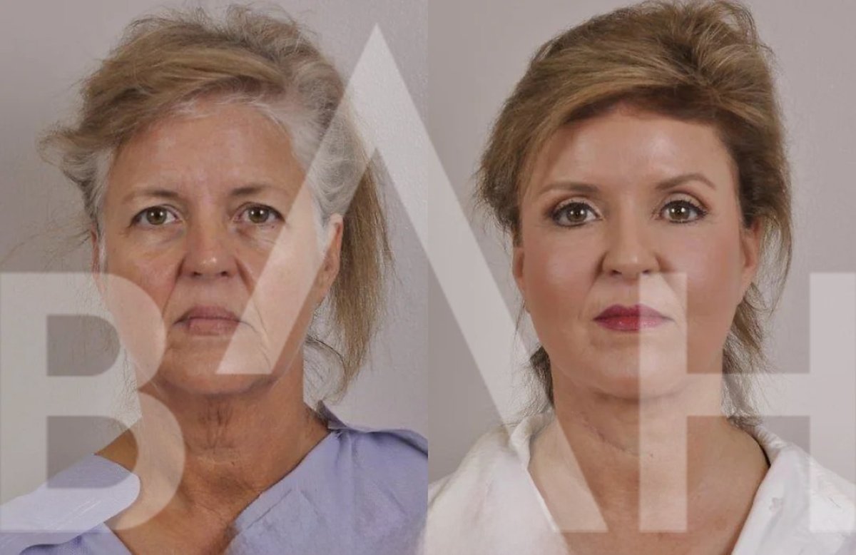 Resultados de lifting facial antes y después en Büyük Anadolu Hospitals (BAH), rejuvenecimiento