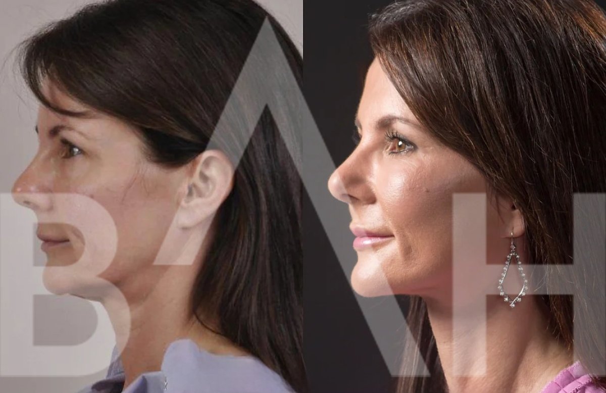 Resultados de lifting facial antes y después en Büyük Anadolu Hospitals (BAH), rejuvenecimiento