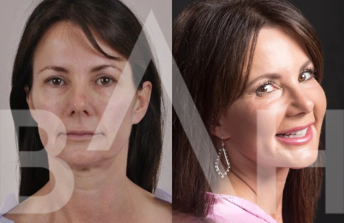 Resultados de lifting facial antes y después en Büyük Anadolu Hospitals (BAH), rejuvenecimiento
