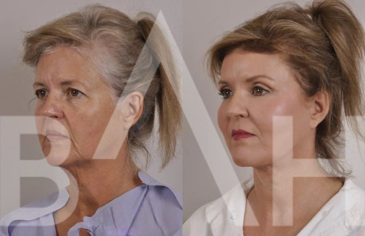 Facelift before and after results at Büyük Anadolu Hospitals (BAH), visible facial rejuvenation