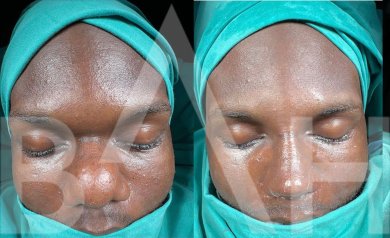 Premium Rhinoplasty (nose job) All Included - photo 5