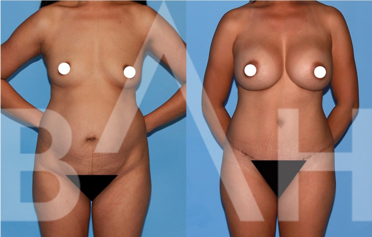 Resultados antes y después de mommy makeover en Büyük Anadolu Hospitals (BAH), contorno corporal