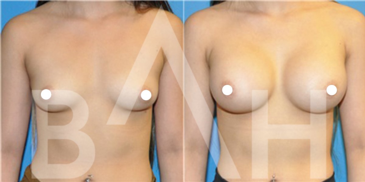 Before and after breast implants with lift results at Büyük Anadolu Hospitals (BAH)