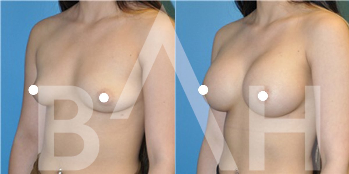 Before and after breast implants with lift results at Büyük Anadolu Hospitals (BAH)