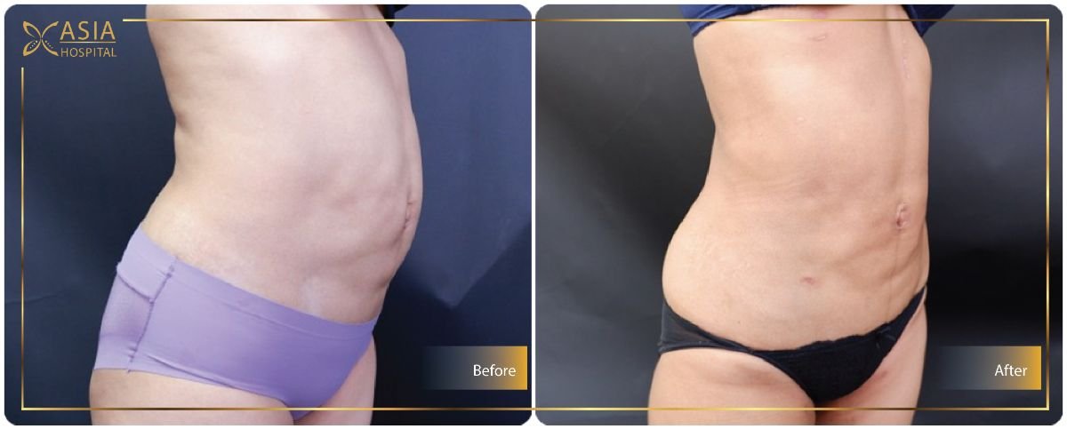 Before and after Vaser liposuction results at Asia Cosmetic Hospital, improved abdominal contour
