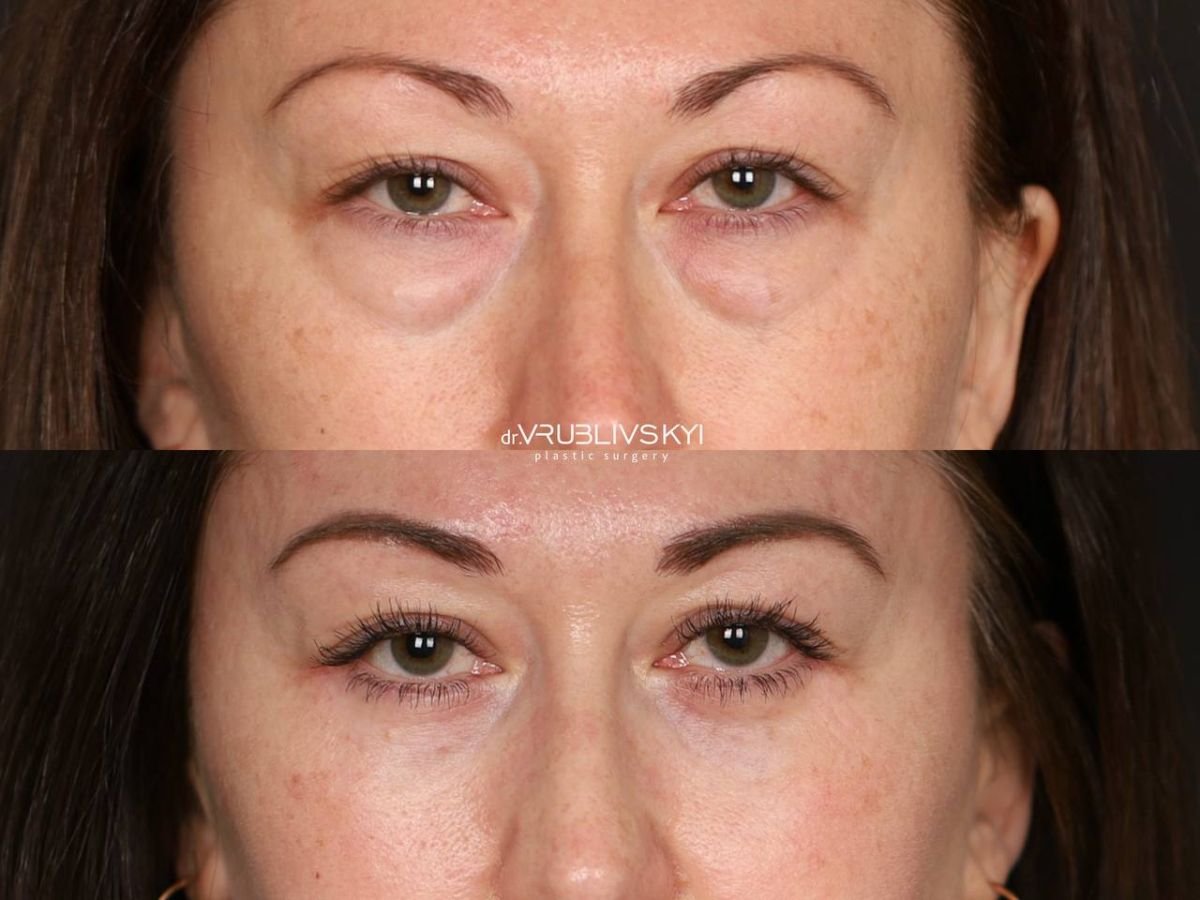 Résultats avant et après blépharoplastie chez Dr. VRUBLIVSKYI Plastic Surgery, correction des paupières