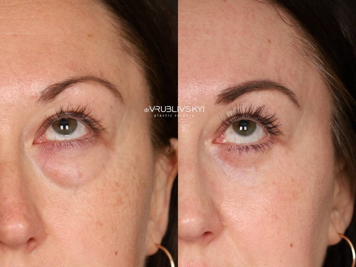 Vorher-nachher-Ergebnis der Blepharoplastik bei Dr. VRUBLIVSKYI Plastic Surgery, Lidkorrektur