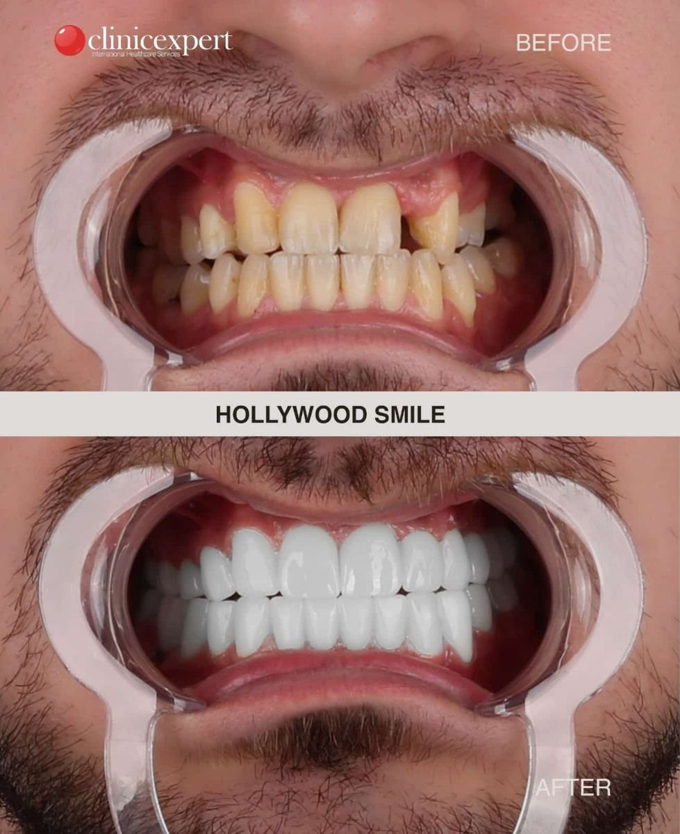 Resultados antes y después de Hollywood Smile en CE International Hospital, transformación con carillas