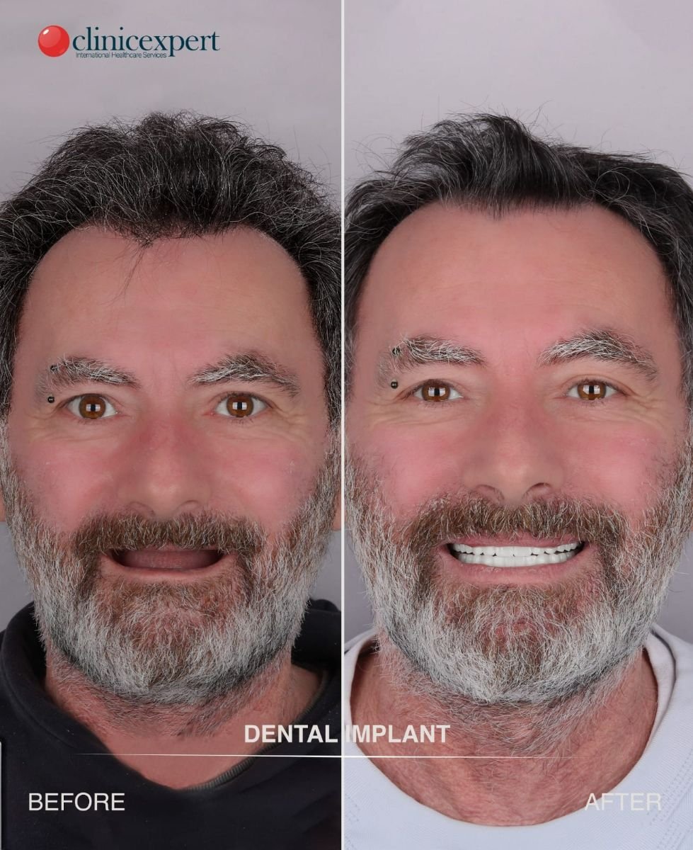 Resultados de implantes dentales antes y después en CE International Hospital, sonrisa mejorada