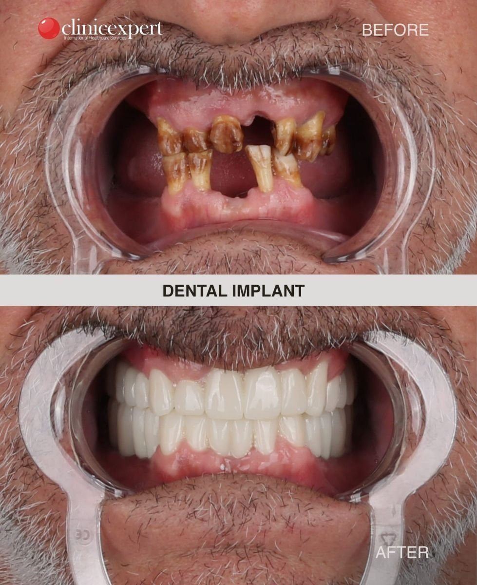 Before and after dental implant results at CE International Hospital – full smile restoration