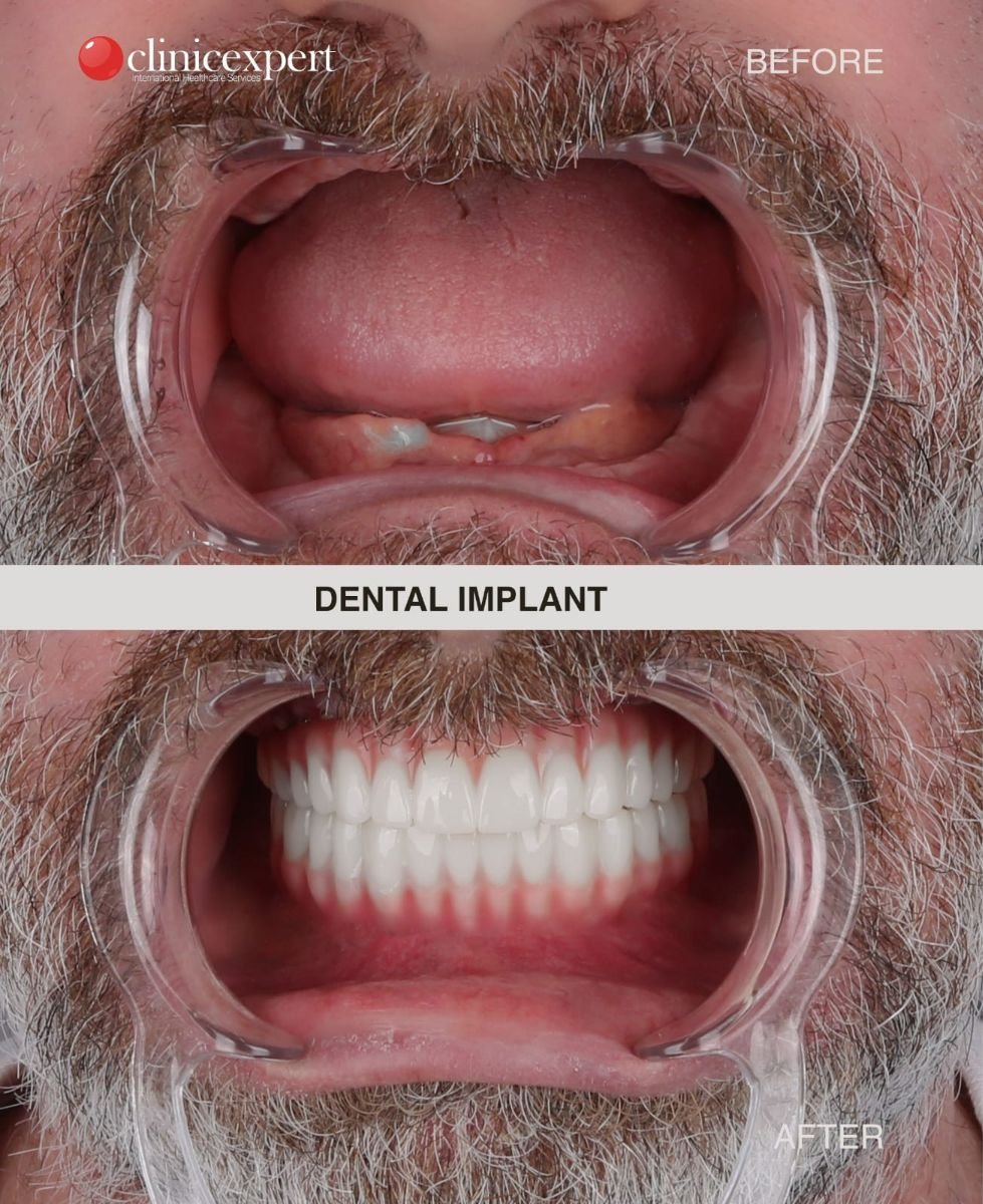Resultados de implantes dentales antes y después en CE International Hospital, restauración total