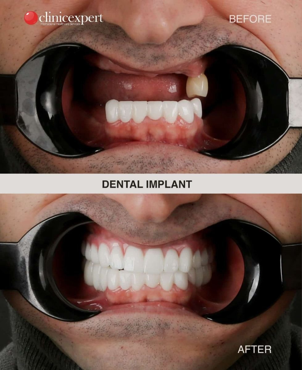 Resultados de implante dental antes y después en CE International Hospital – sonrisa restaurada