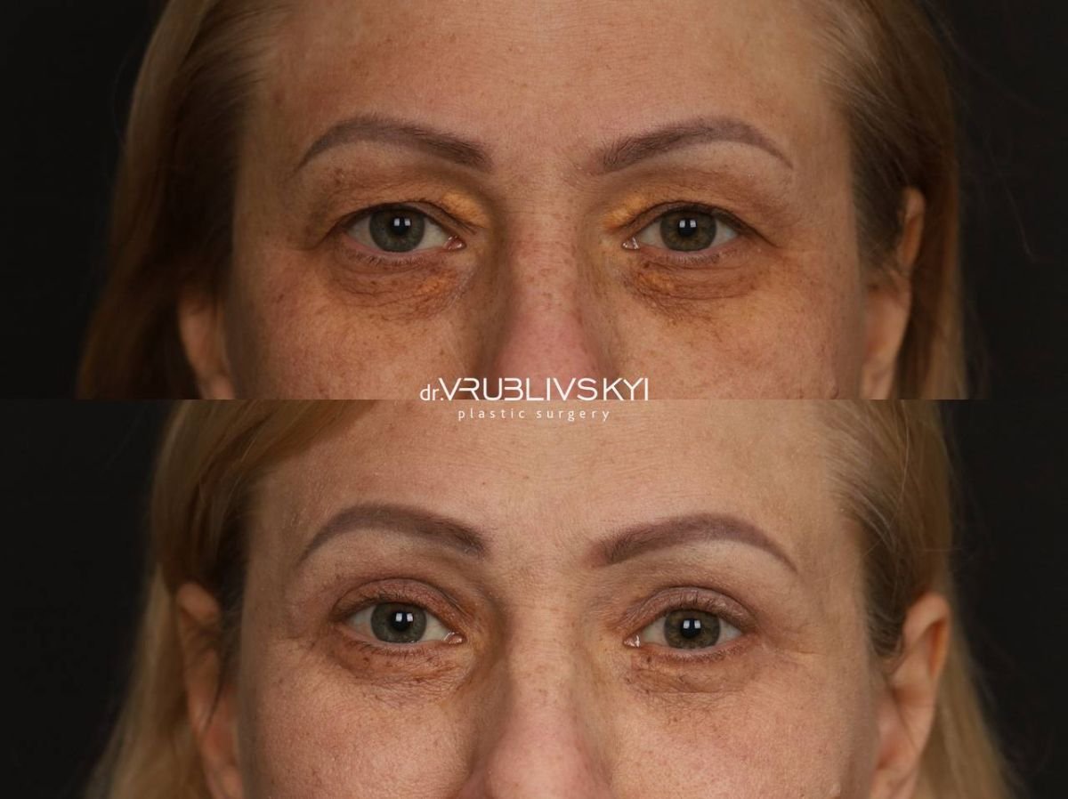 Before and after blepharoplasty results at Dr. VRUBLIVSKYI Plastic Surgery, eyelid correction
