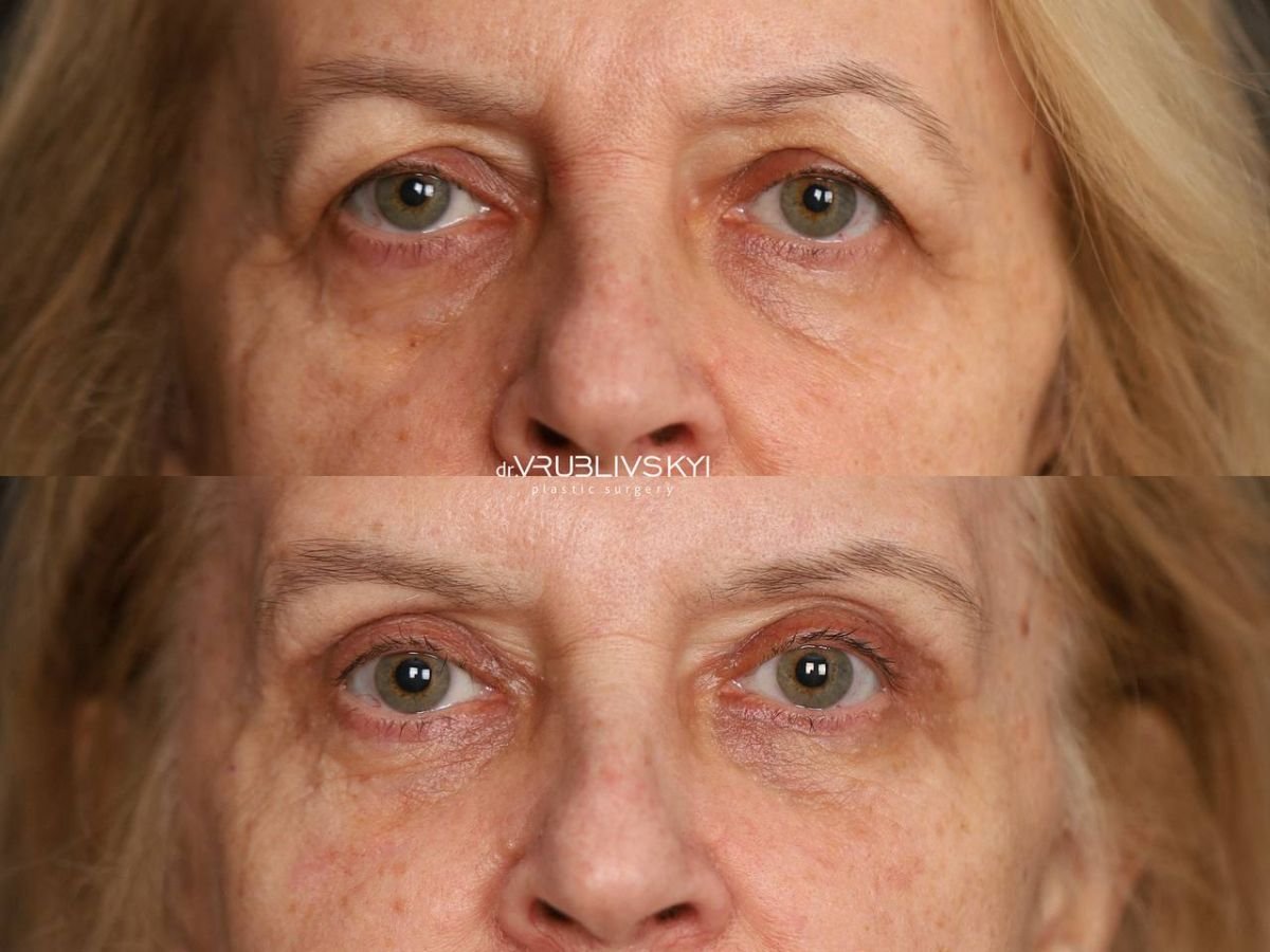 نتائج شد الجفون قبل وبعد في Dr. VRUBLIVSKYI Plastic Surgery، تصحيح الجفون