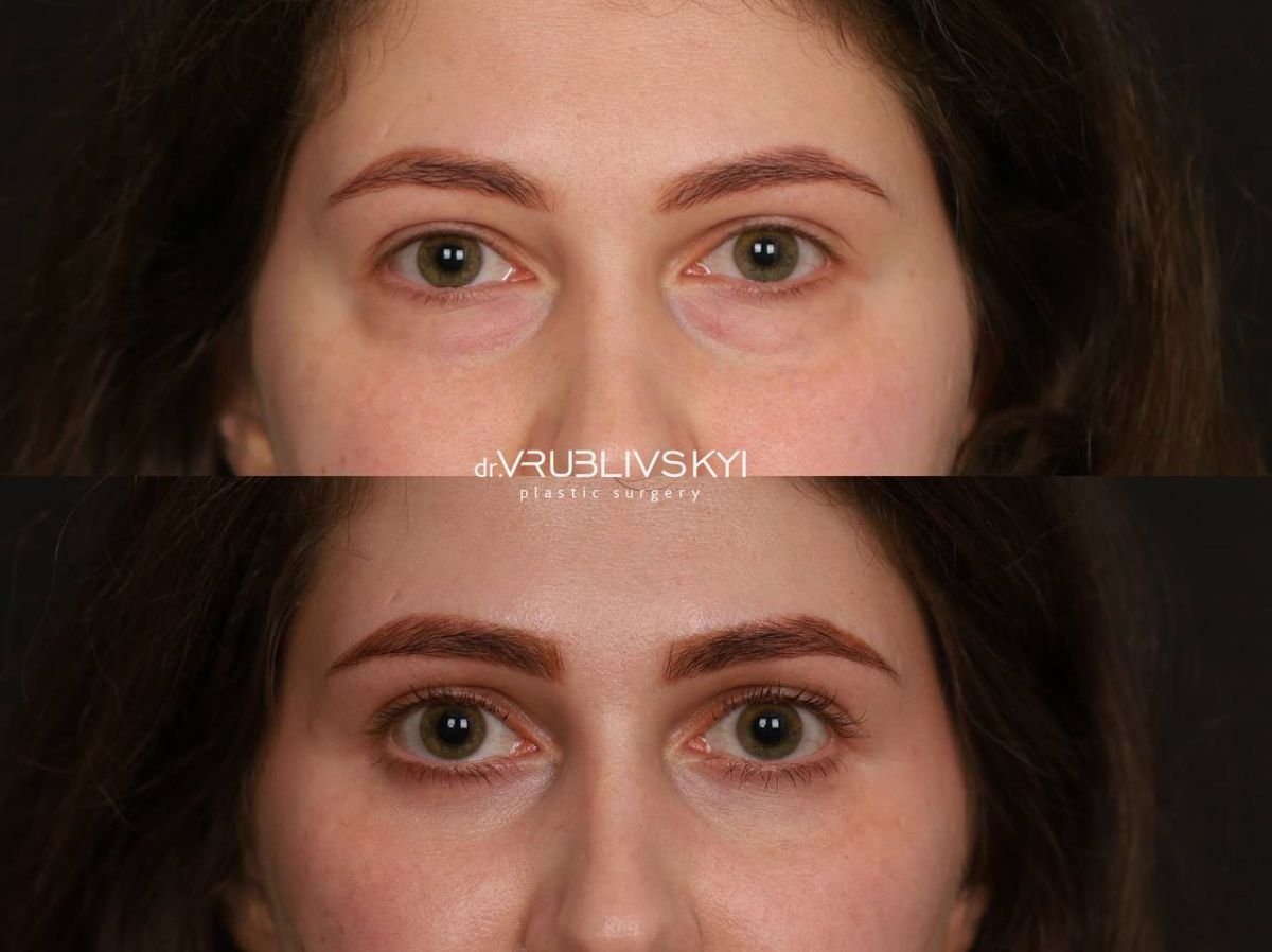 نتائج رأب الجفن قبل وبعد في Dr. VRUBLIVSKYI Plastic Surgery، تصحيح الجفون