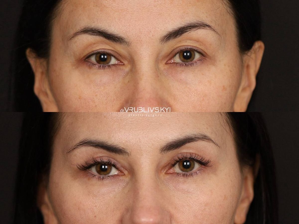 Before and after blepharoplasty results at Dr. VRUBLIVSKYI Plastic Surgery, eyelid correction