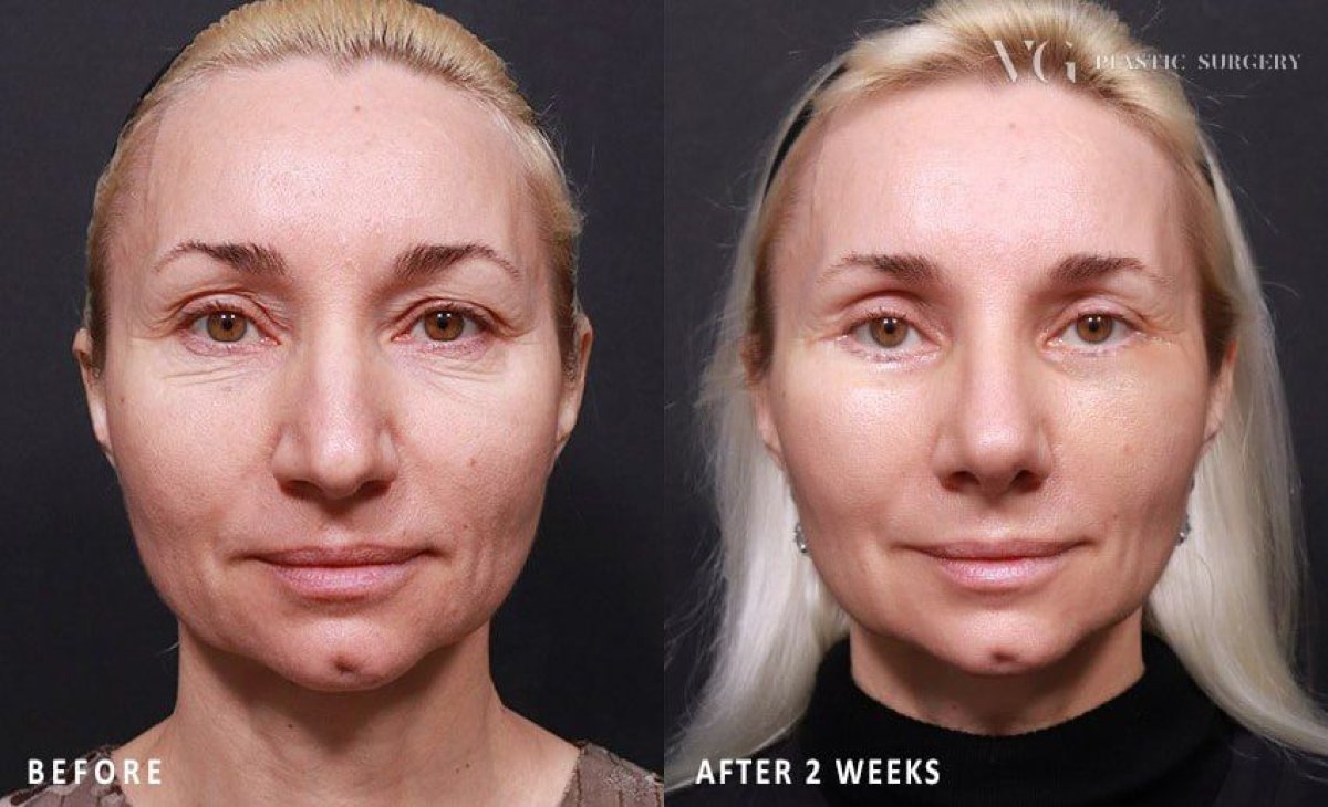 Résultats avant/après extraction de boules de Bichat chez VG Plastic Surgery – visage affiné