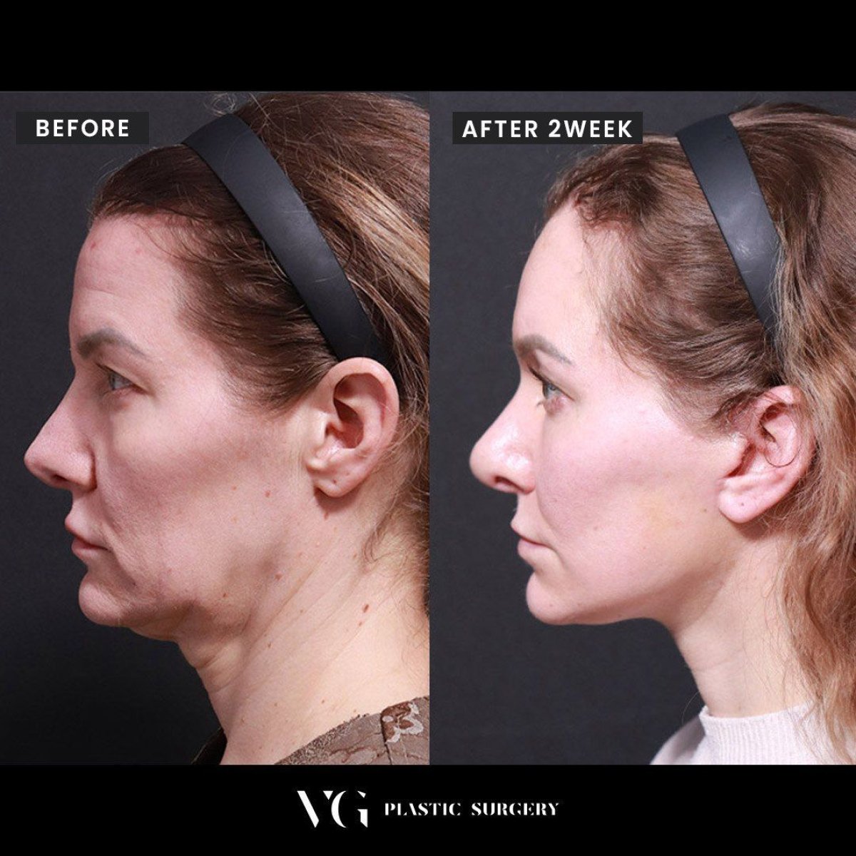 Resultados de liposucción de mentón antes y después en VG Plastic Surgery – contorno mejorado