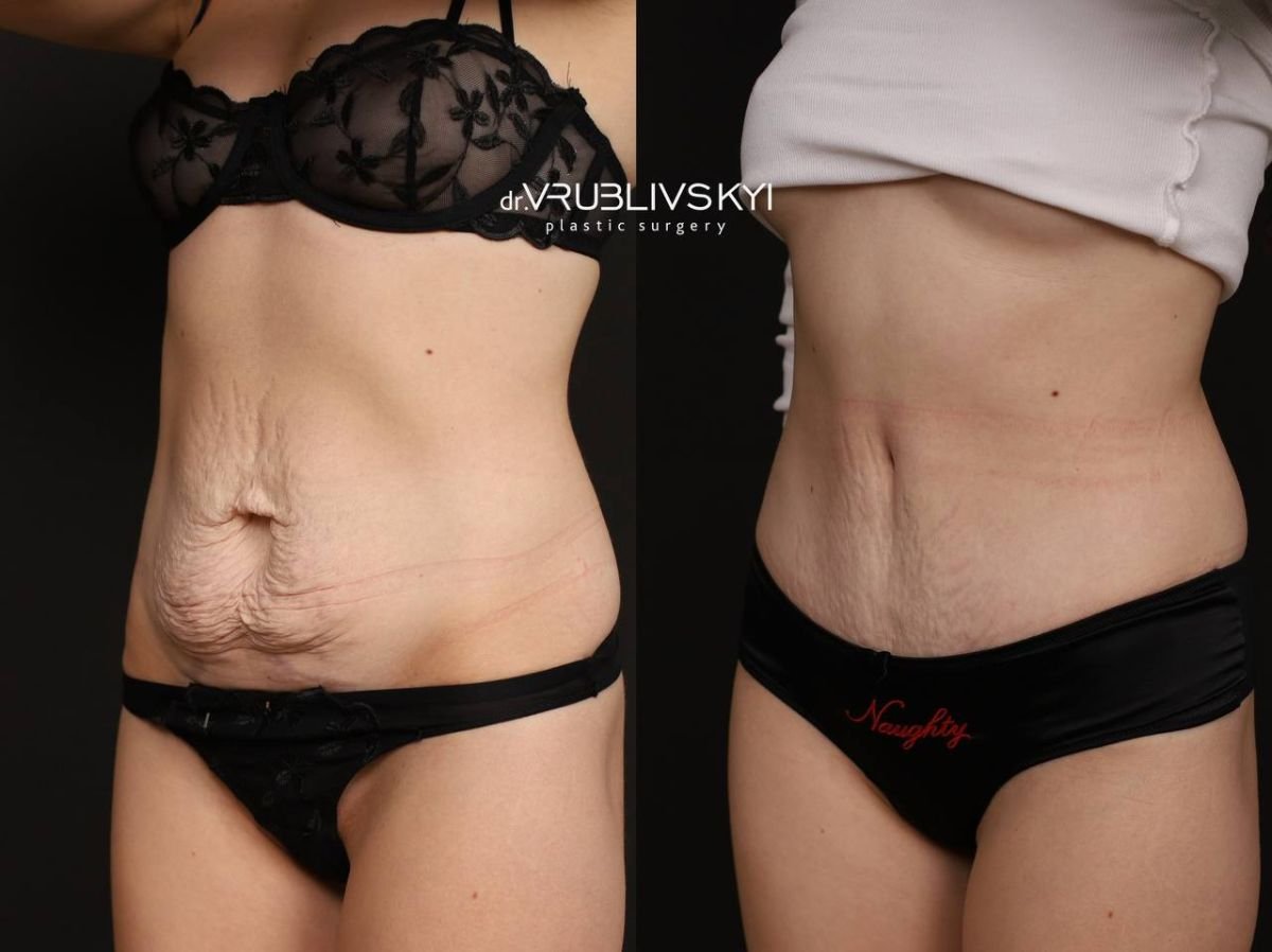 نتائج شد البطن قبل وبعد في Dr. VRUBLIVSKYI Plastic Surgery، بطن مسطح
