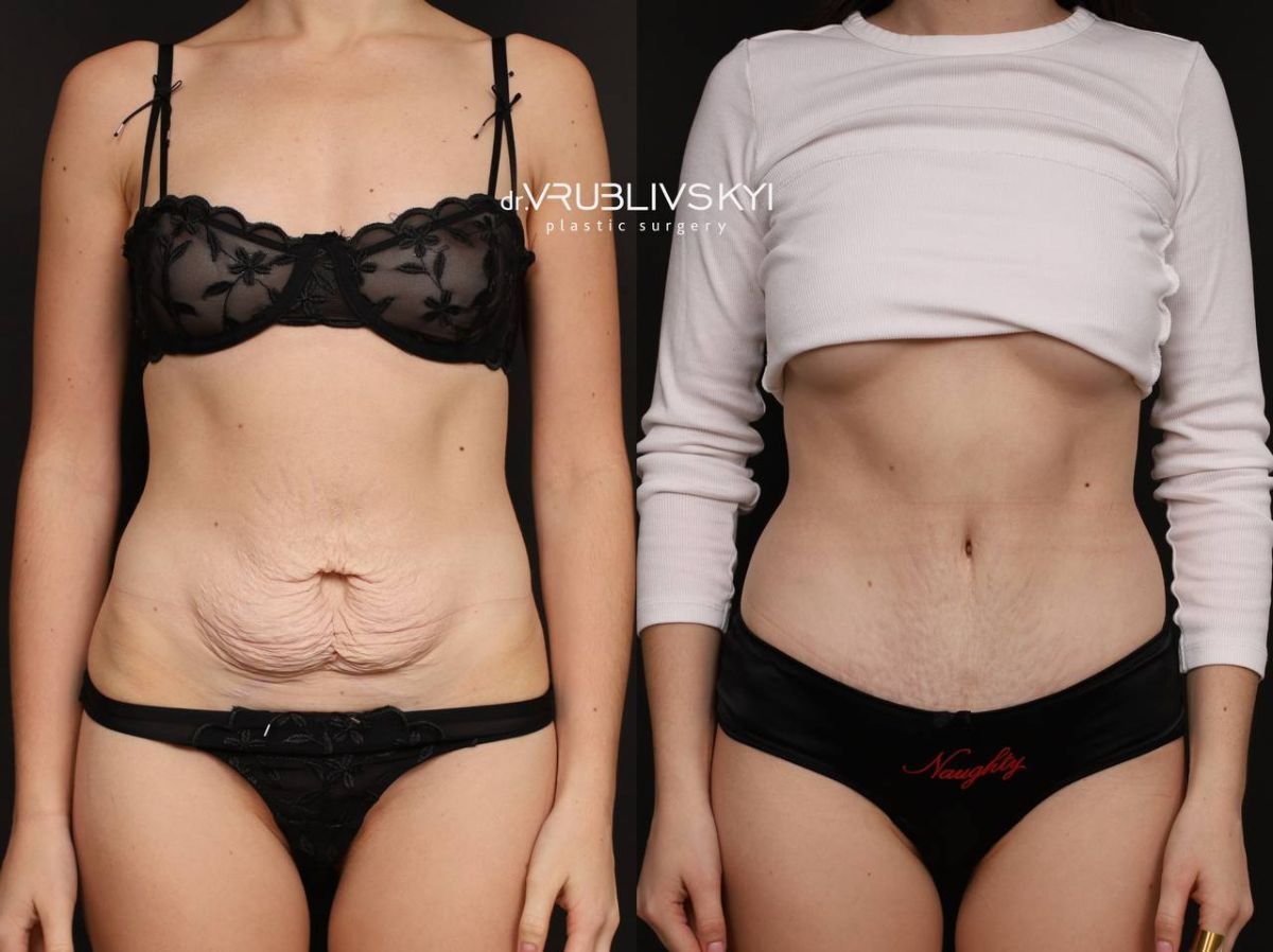 نتائج شد البطن قبل وبعد في Dr. VRUBLIVSKYI Plastic Surgery، تحسين شكل البطن