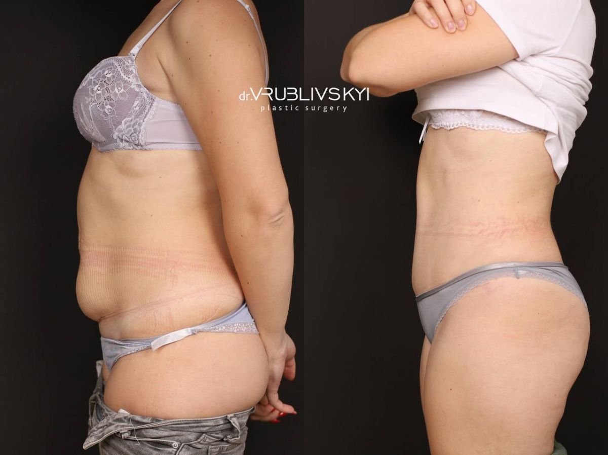 Before and after tummy tuck results at Dr. VRUBLIVSKYI Plastic Surgery, flatter abdomen
