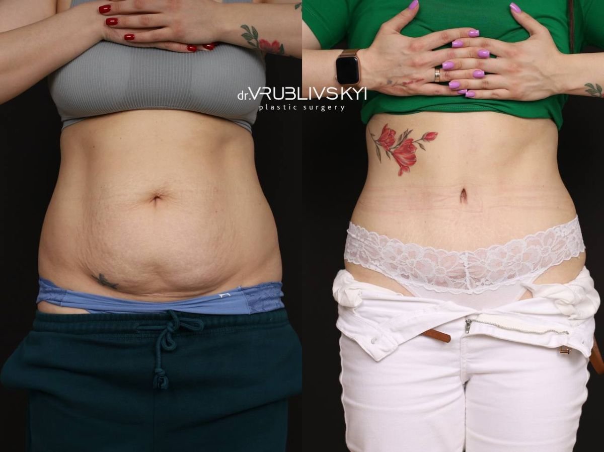 Before and after tummy tuck results at Dr. VRUBLIVSKYI Plastic Surgery, flatter abdomen