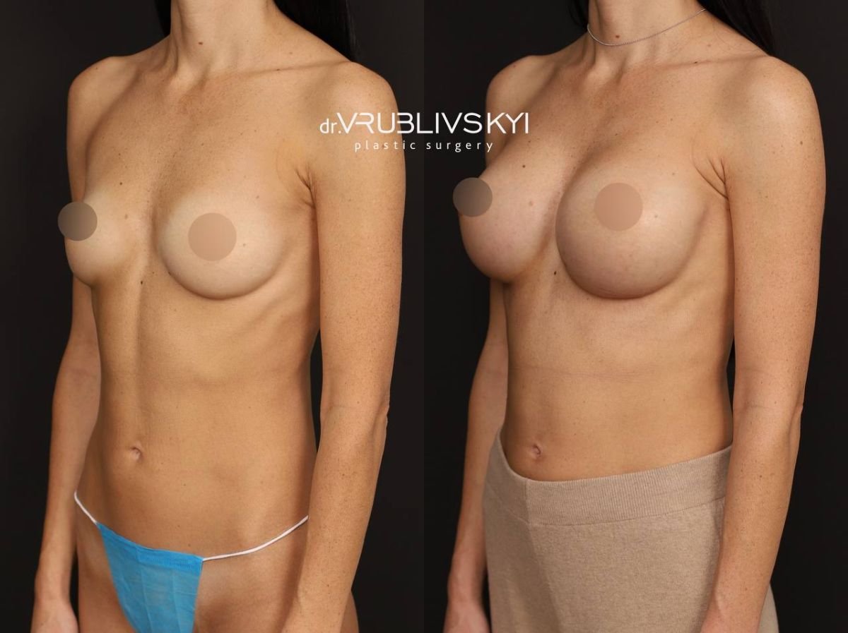 Before and after mammoplasty results at Dr. VRUBLIVSKYI Plastic Surgery, breast augmentation