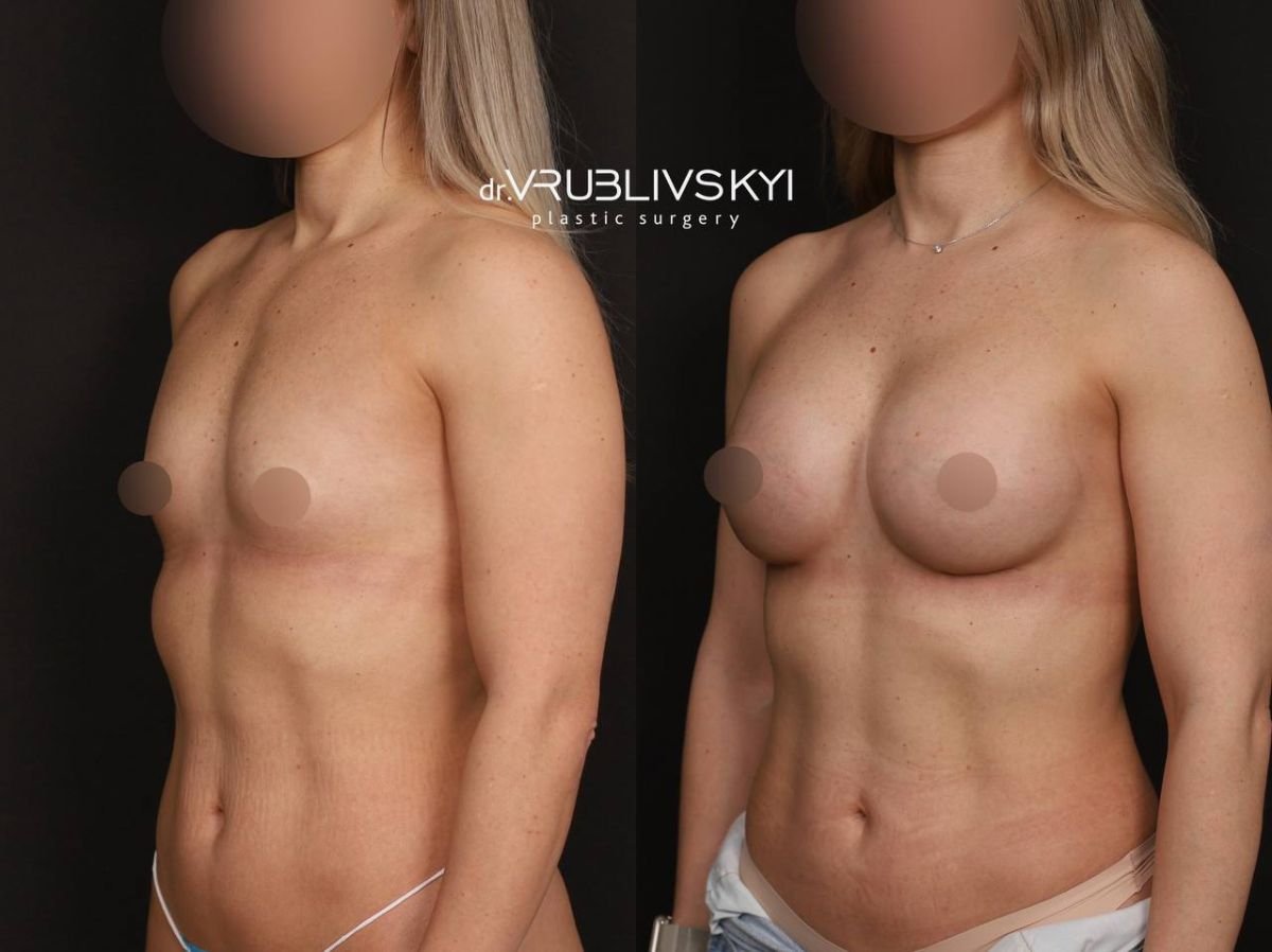 Before and after mammoplasty results at Dr. VRUBLIVSKYI Plastic Surgery, breast augmentation