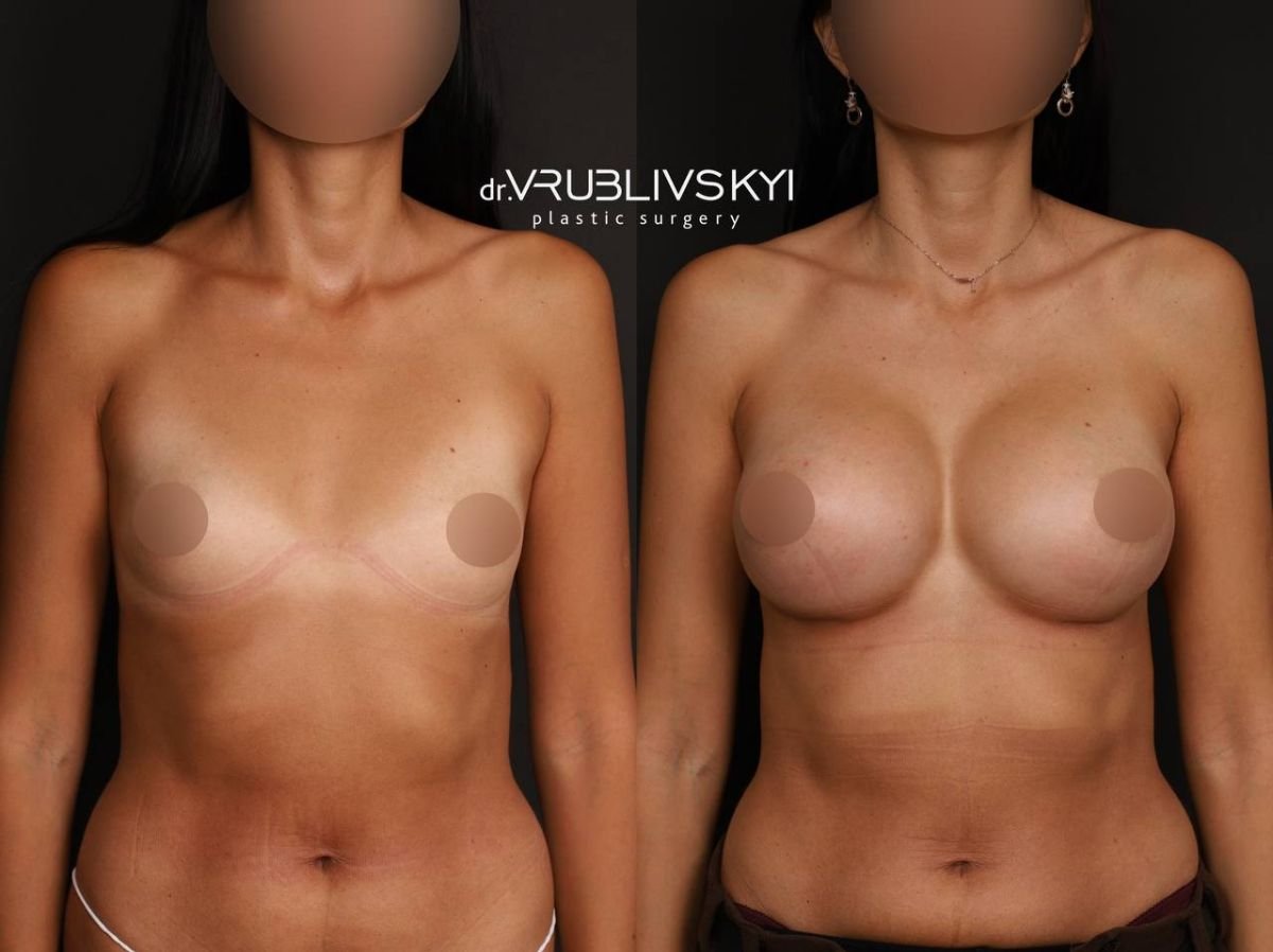 Before and after mammoplasty results at Dr. VRUBLIVSKYI Plastic Surgery, breast augmentation