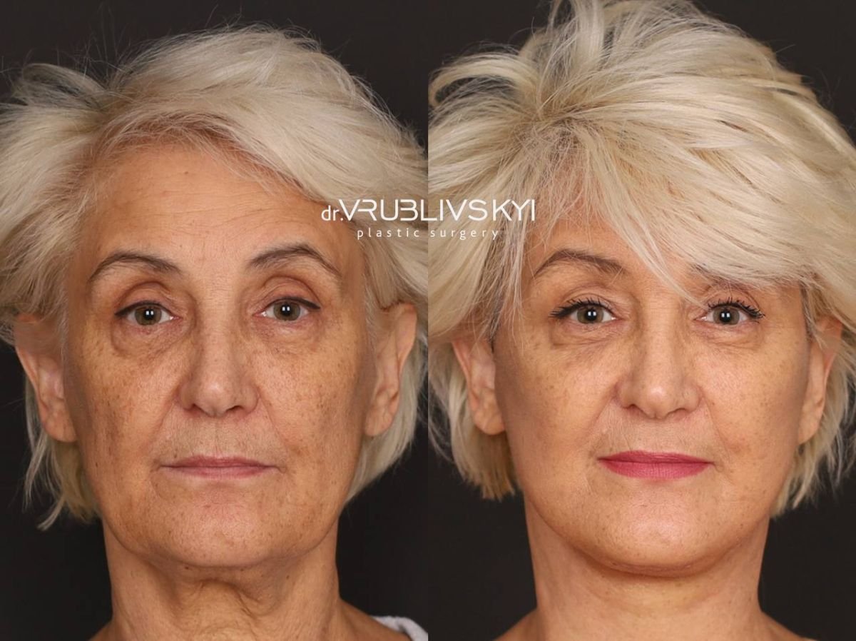 Facelift Vorher-Nachher-Ergebnisse bei Dr. VRUBLIVSKYI Plastic Surgery, sichtbare Verjüngung