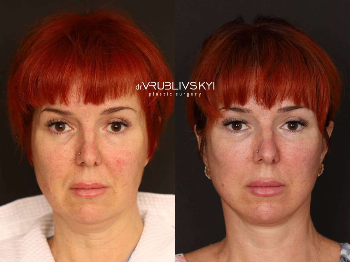 نتائج شد الوجه قبل وبعد في Dr. VRUBLIVSKYI Plastic Surgery، تجديد شباب الوجه