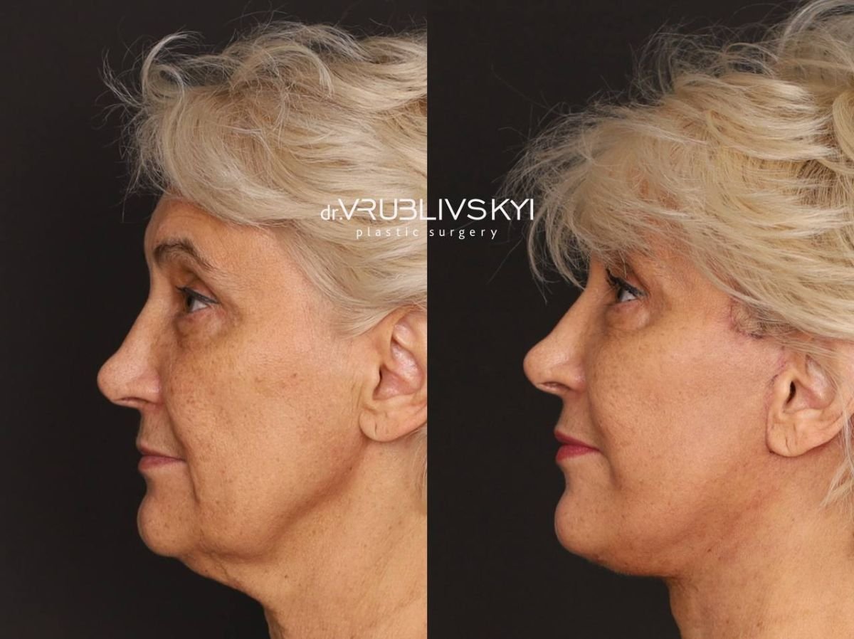 Facelift before and after results at Dr. VRUBLIVSKYI Plastic Surgery, visible facial rejuvenation